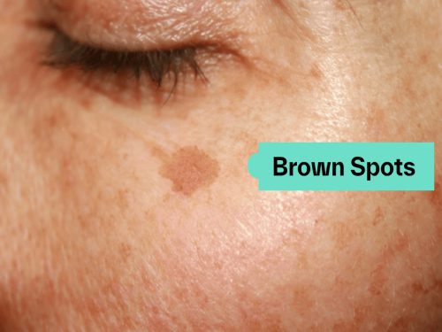 Dark pigmentation on facial skin close-up