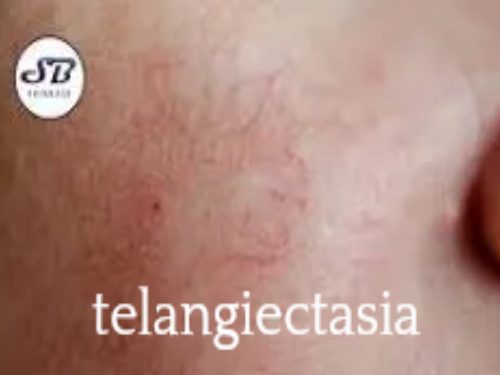 Close-up of skin with telangiectasia