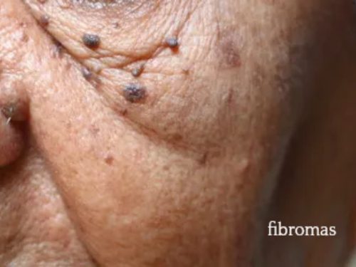 Skin growths near eye area