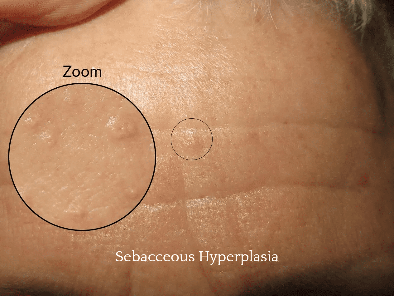 Forehead showing sebaceous hyperplasia details