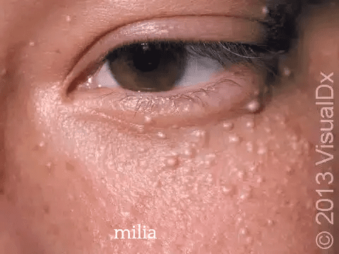 Eye area showing milia condition