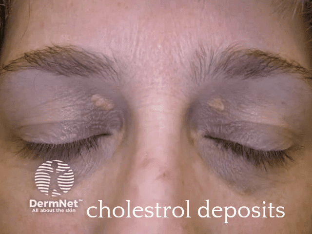 Skin condition on upper eyelids