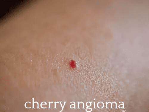 Red mole on human skin surface.