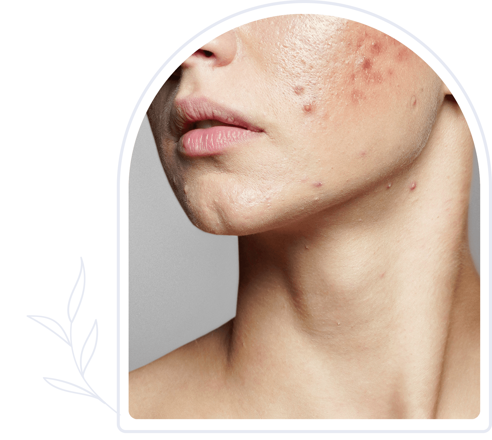 Woman's face with acne and blemishes