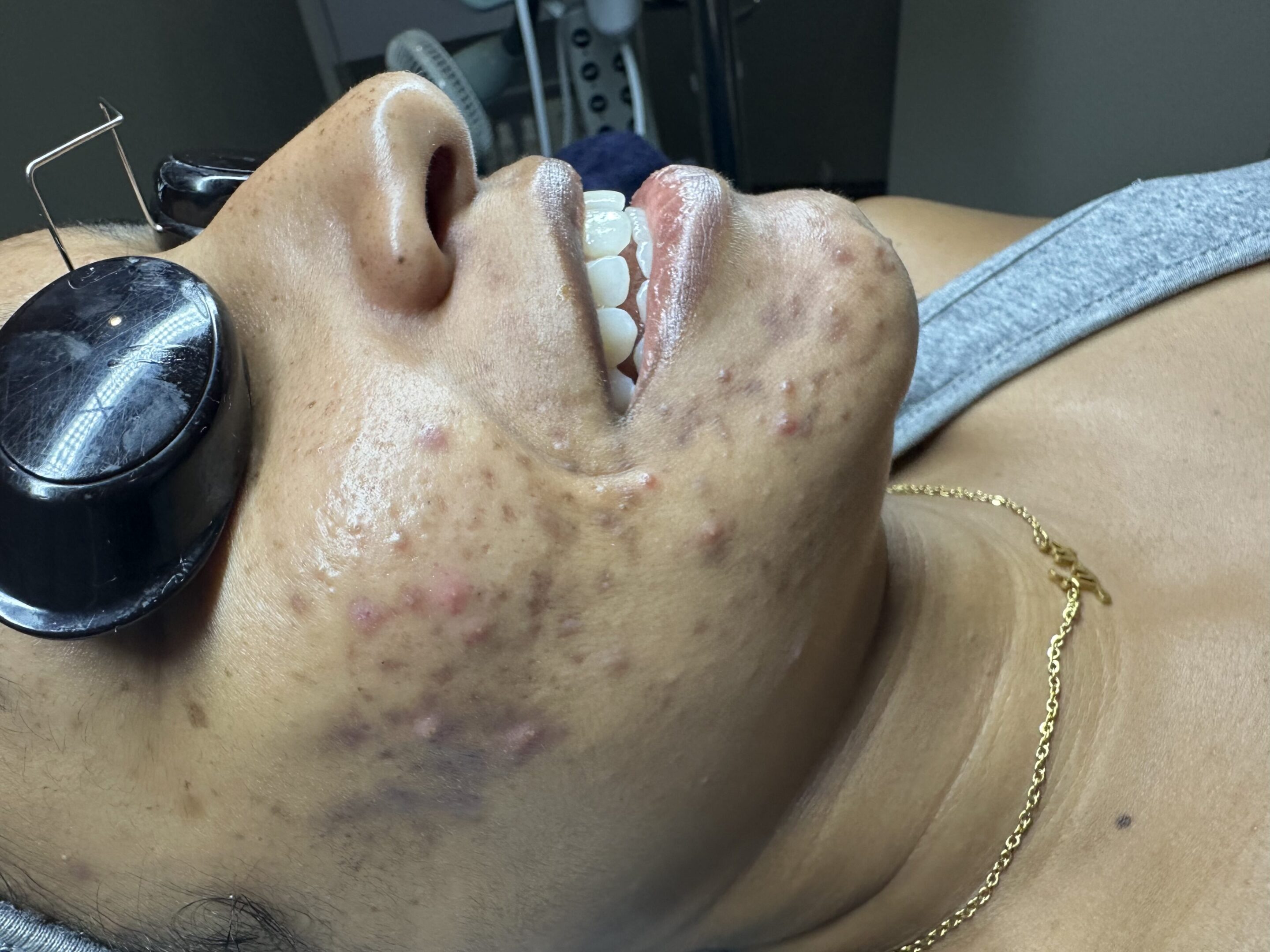 Facial treatment with protective eyewear