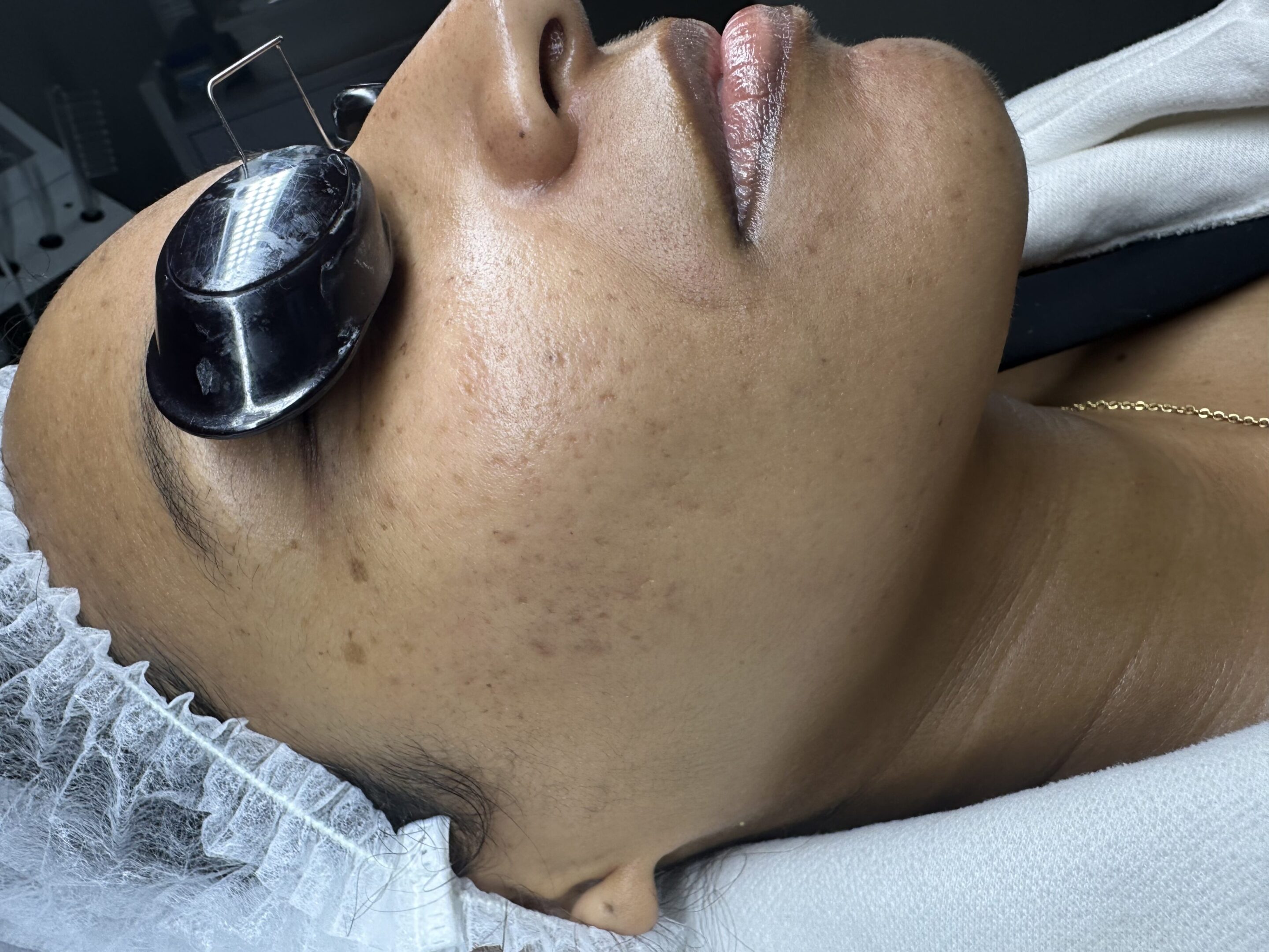 Facial laser procedure with safety eyewear