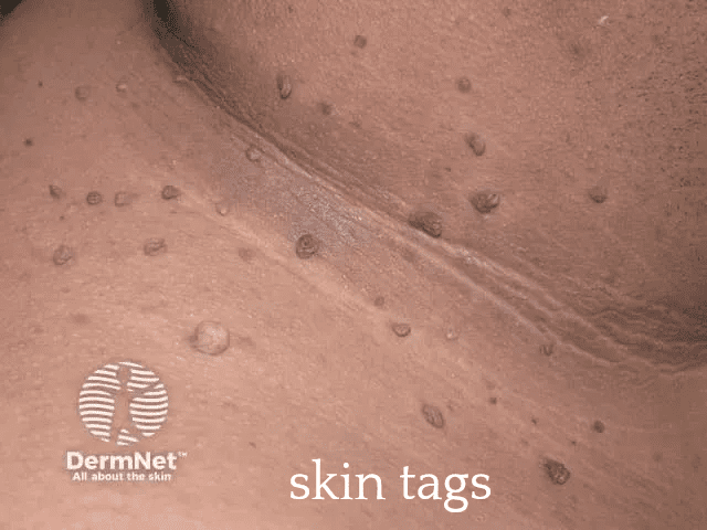 Close-up of skin tags on neck