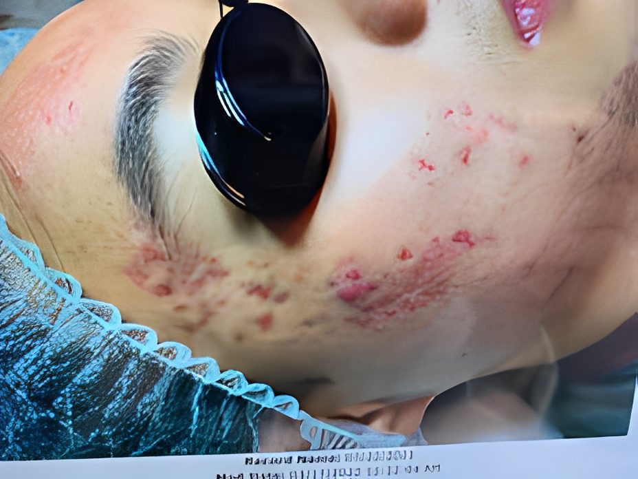 Skincare session for acne reduction
