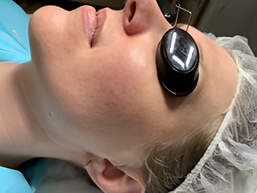 Person receiving facial treatment with goggles