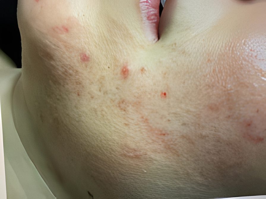 Acne on a person's jawline