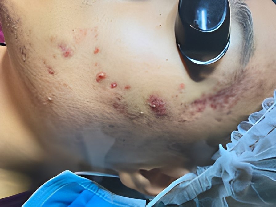 Skin with acne and medical tool
