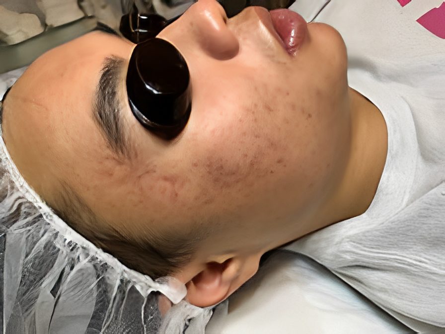 Close-up of a face during skincare session