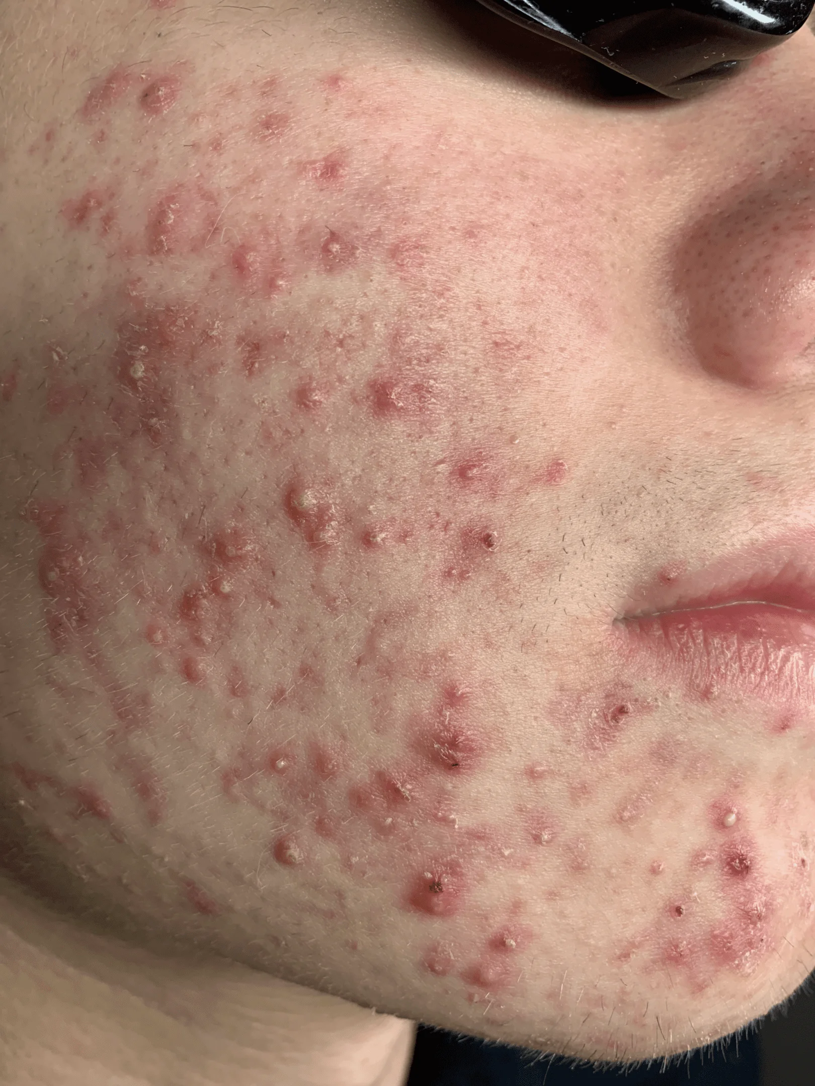 Red inflamed pimples on face