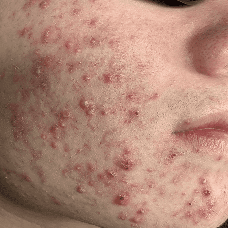 Skin with red acne spots