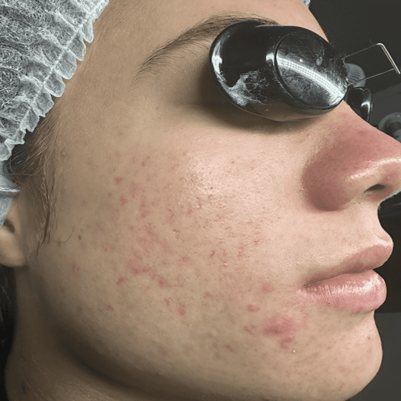 Dermatology procedure with protective eyewear