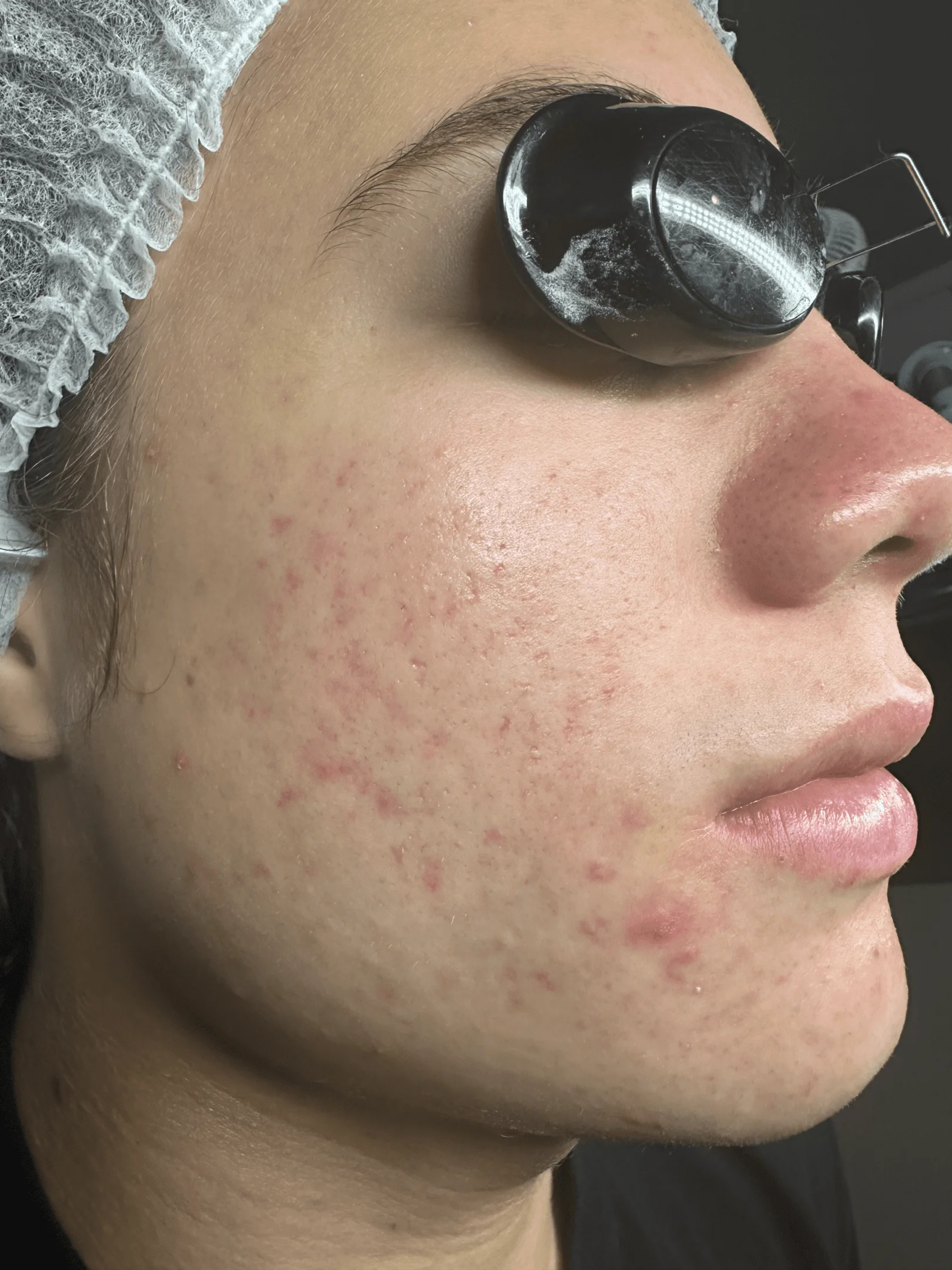Close-up of acne-prone skin
