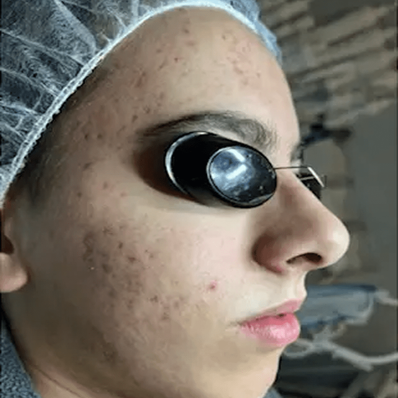 Facial protection during dermatology procedure