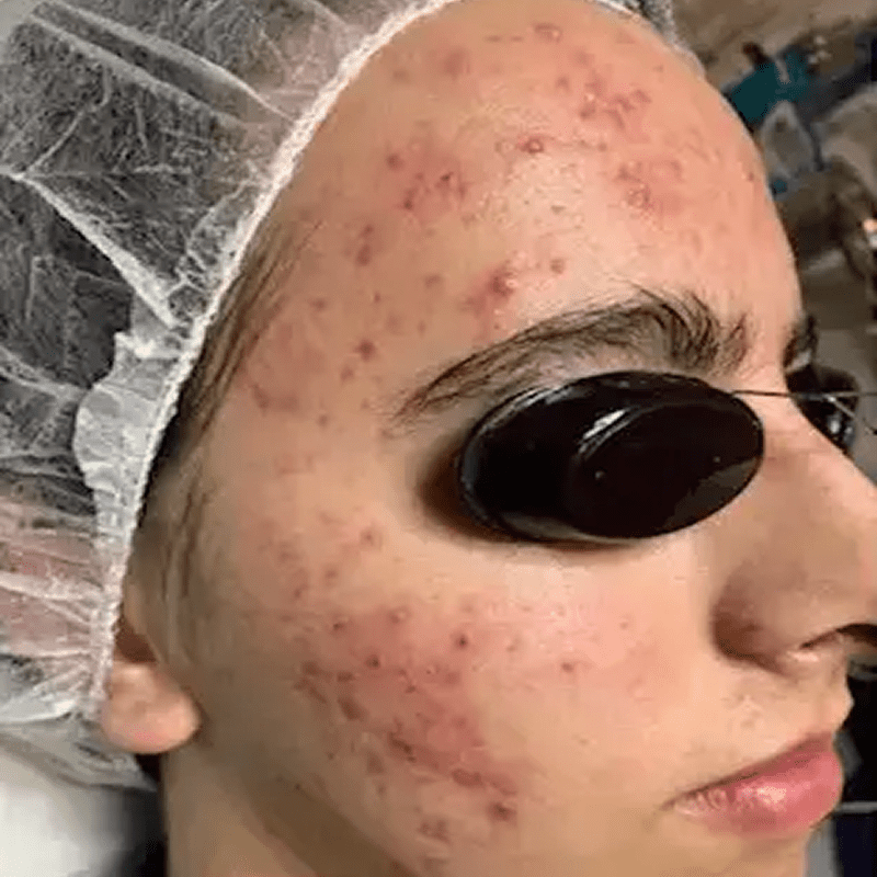 Person with acne undergoing skin treatment
