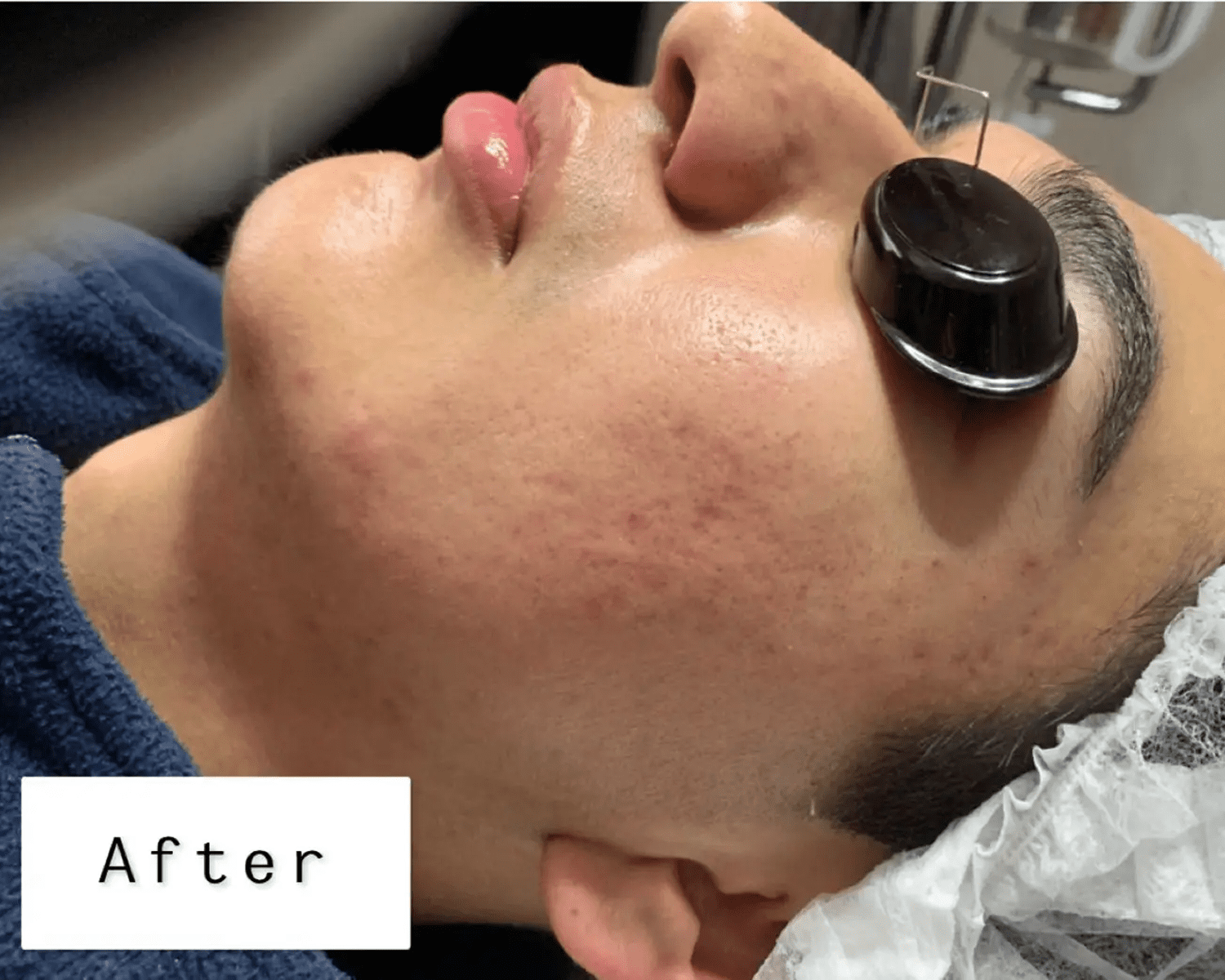 Skincare session post-treatment