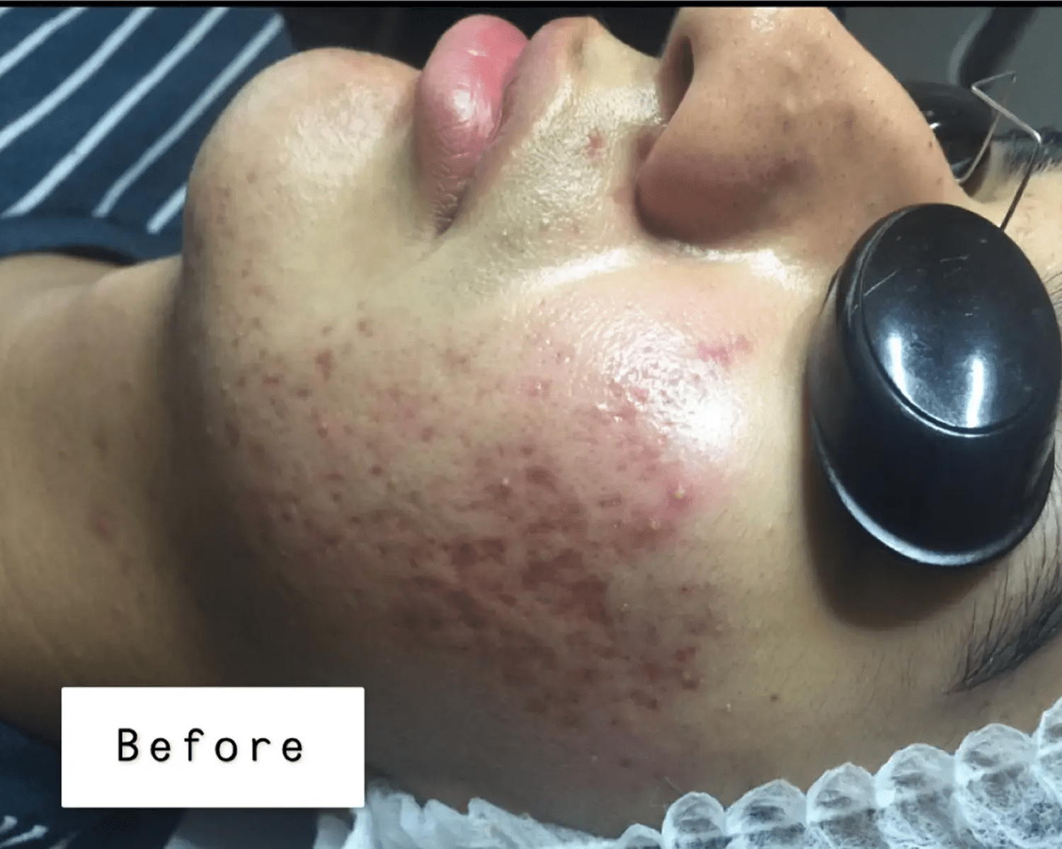 Skin with acne before treatment
