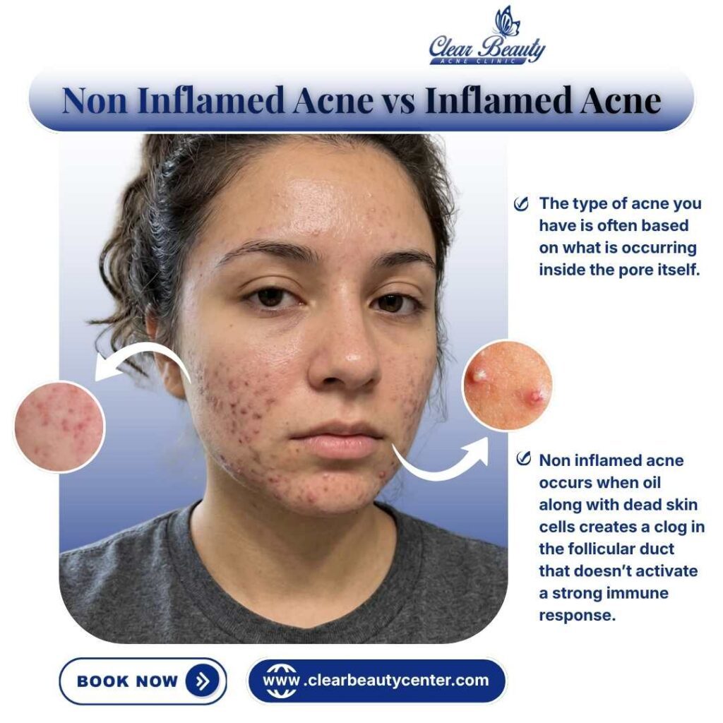 Non Inflamed Acne vs Inflamed Acne in Frisco, TX