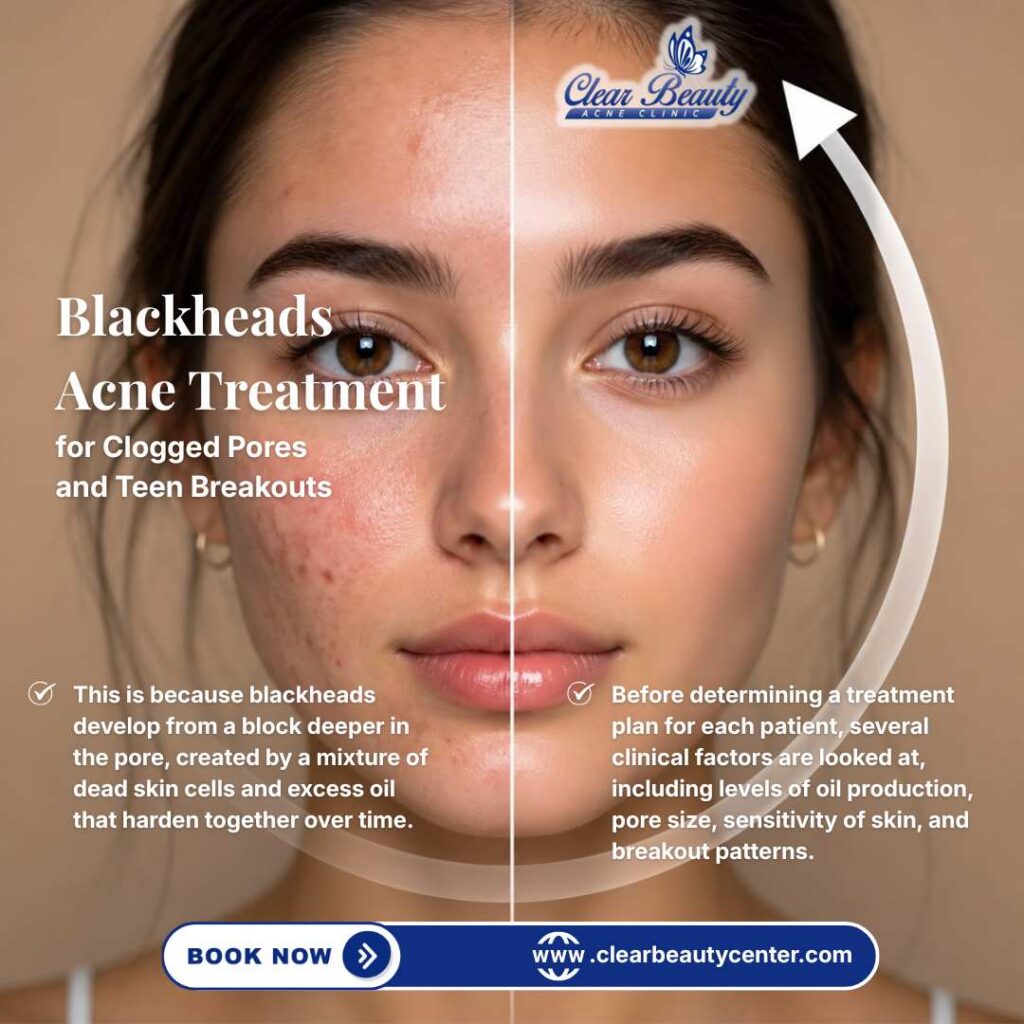 Blackheads Acne Treatment in Frisco, TX, for Clogged Pores and Teen Breakouts