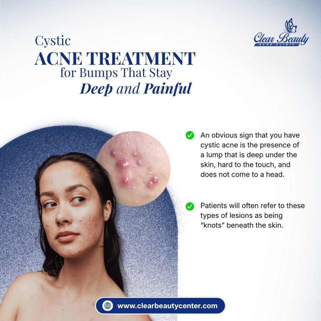 Cystic Acne Treatment in Frisco, TX, for Bumps That Stay Deep and Painful