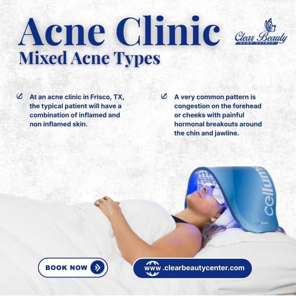 Acne Clinic in Frisco, TX, for Mixed Acne Types