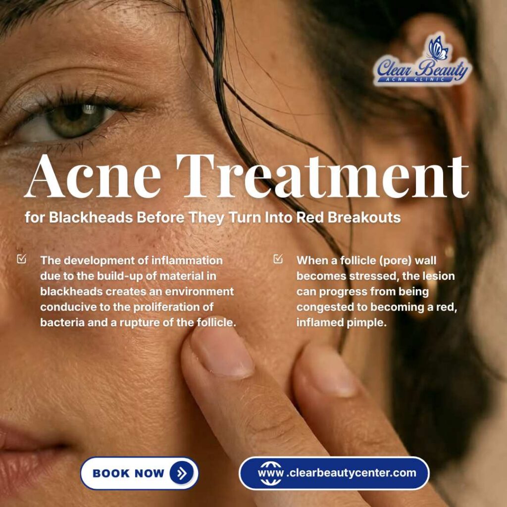 Acne Treatment in Frisco, TX, for Blackheads Before They Turn Into Red Breakouts