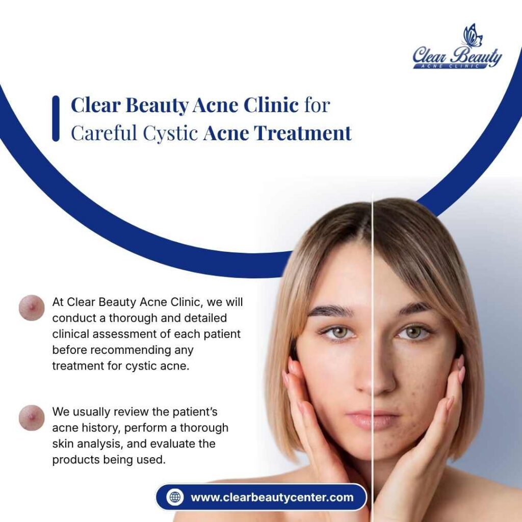 Clear Beauty Acne Clinic for Careful Cystic Acne Treatment in Frisco, TX